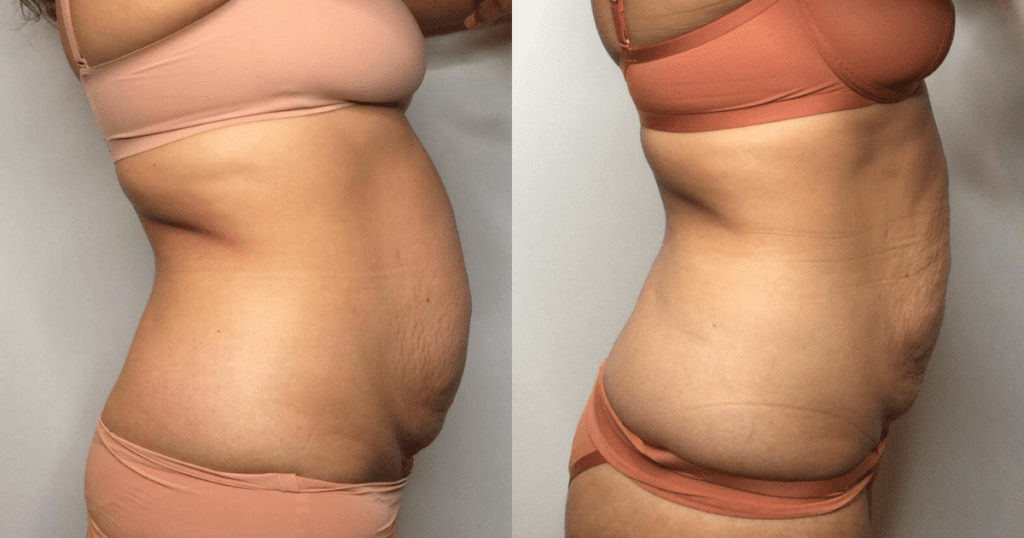 How EmSculpt NEO can help improve Diastasis Recti