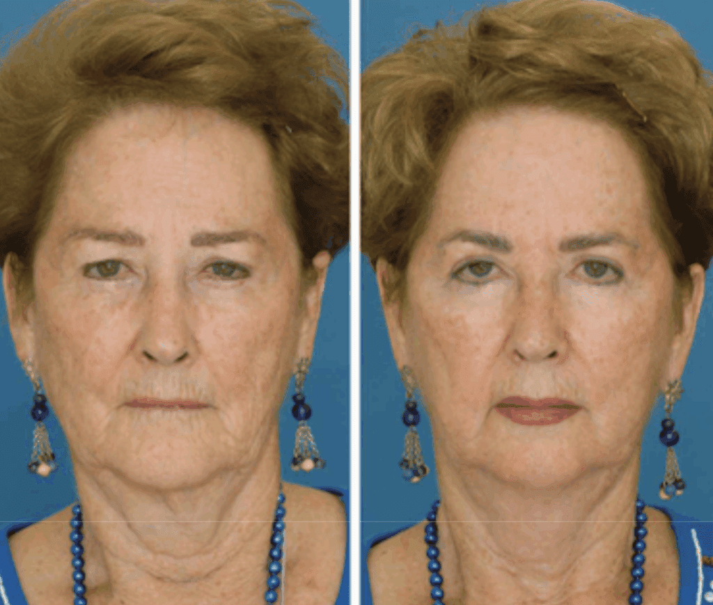  facial aging of identical twins